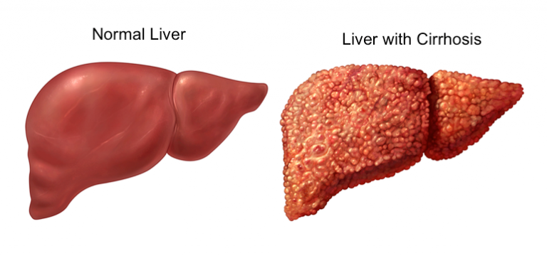 what is liver infection